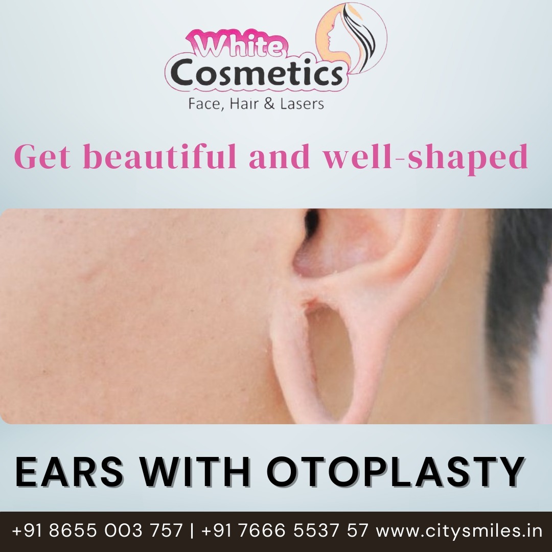  Transform Your Ears with Otoplasty! 