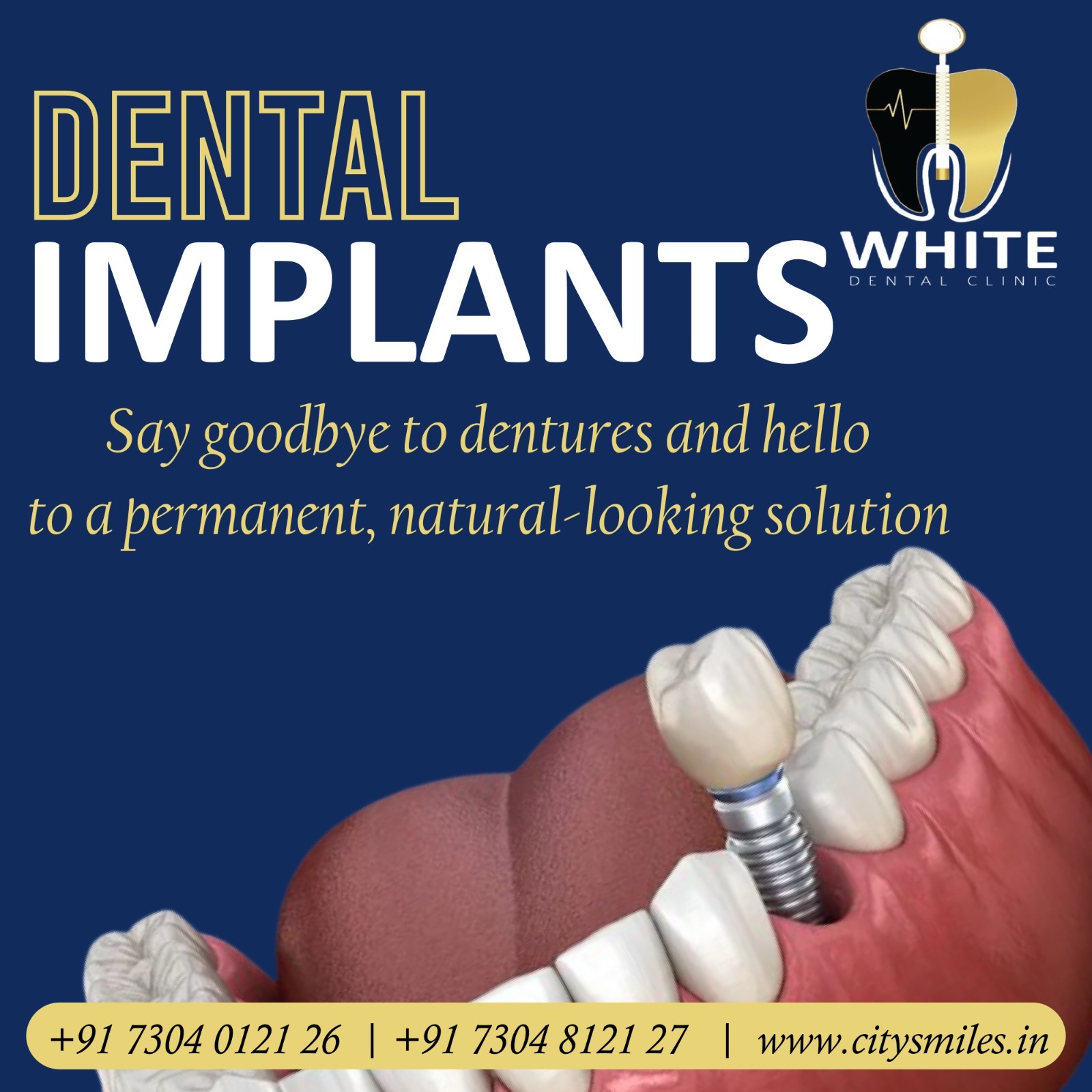 DENTAL IMPLANTS at WHITE