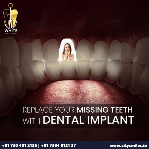  Restore Your Smile with Dental Implants at Wite Dental! 