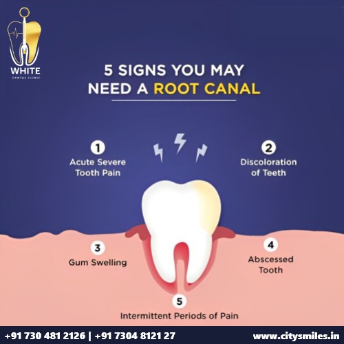 5 Signs You May Need a Root Canal – White Dental Clinic, Nerul, Navi Mumbai