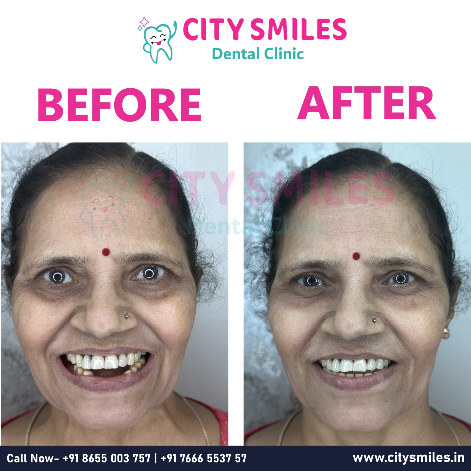 Before vs After – Happy Patients, Beautiful Smiles!