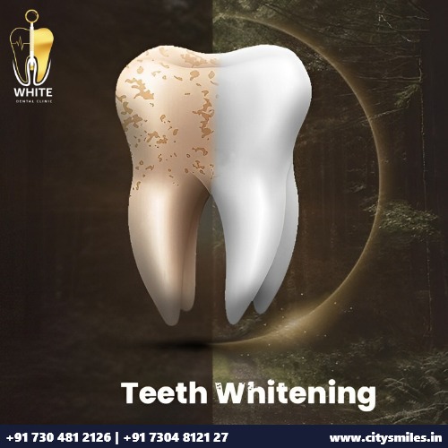 Brighten Your Smile with Teeth Whitening