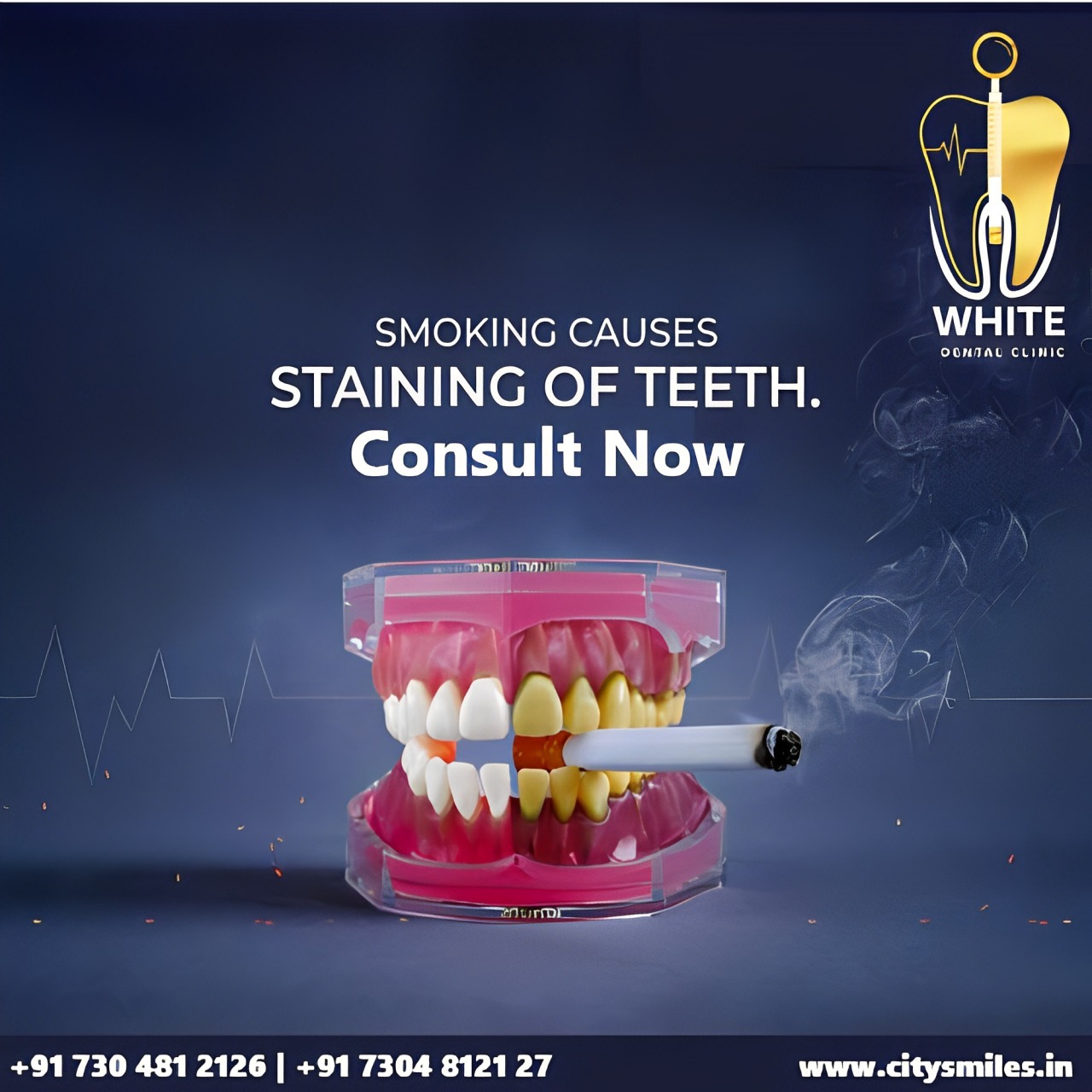 Smoking Causes Staining of Teeth - Consult White Dental Now