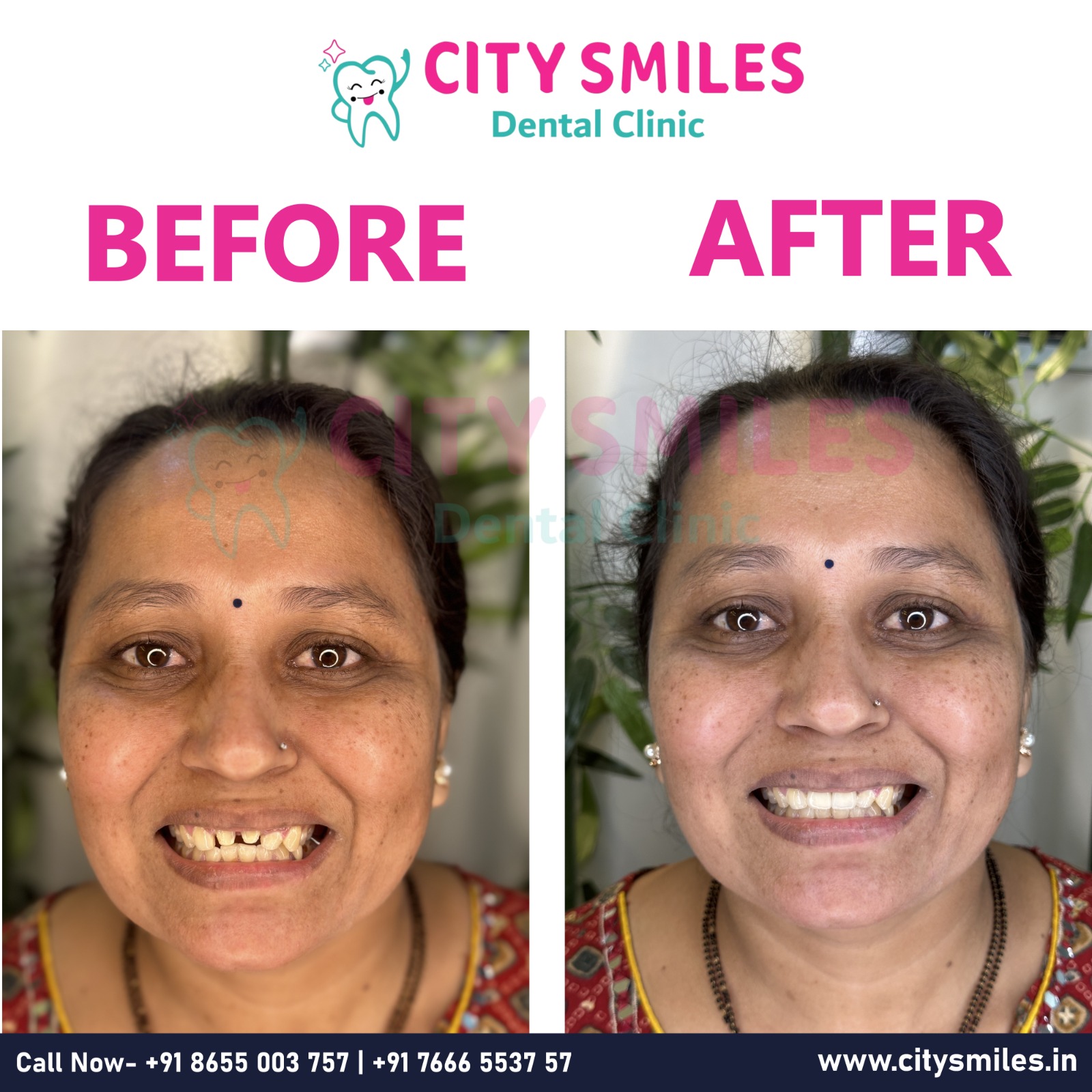 Smile Transformation at City Smiles Dental Clinic: A Stunning EMAX Crown Makeover