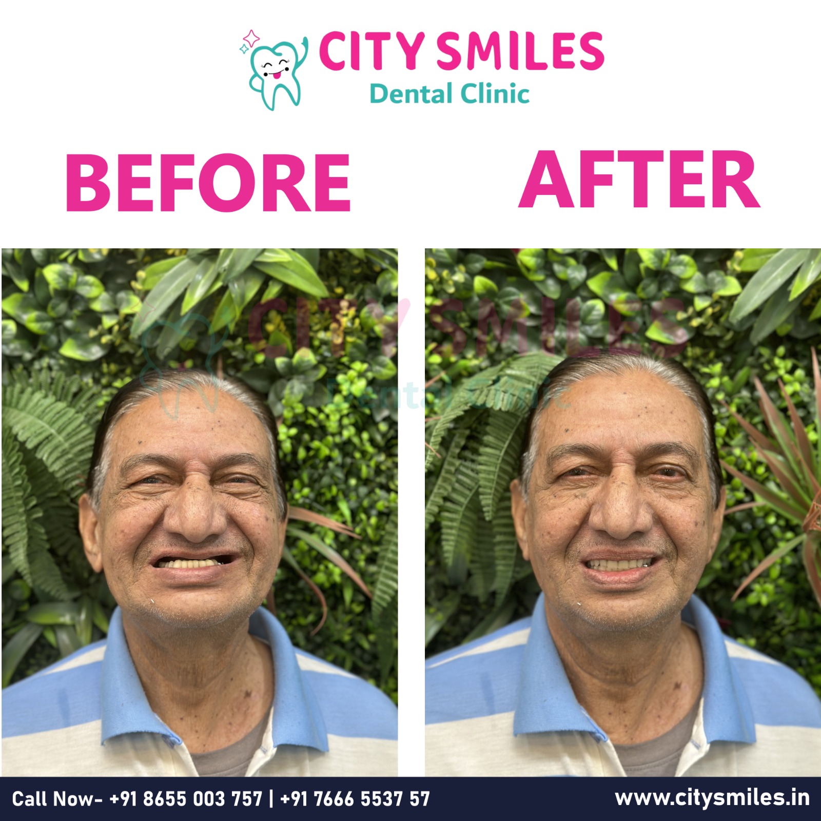 Before vs After: A Complete Smile Transformation!