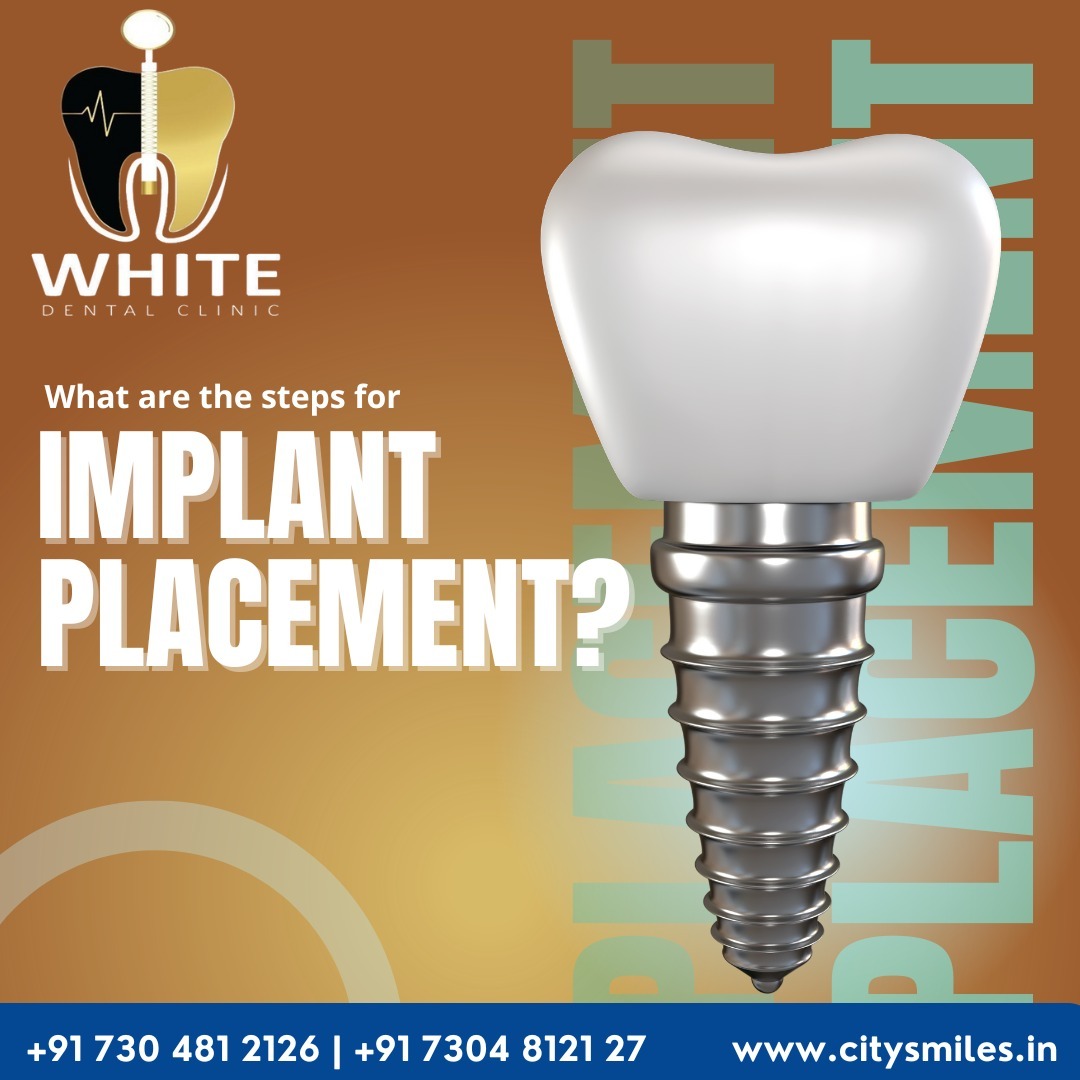 Steps for Implant Placement at White Dental Clinic