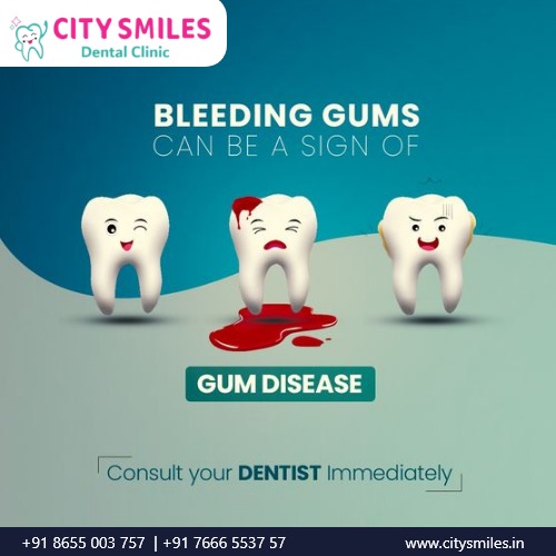  BLEEDING GUMS  ?