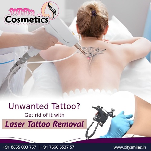 Say Goodbye to Unwanted Tattoos with Laser Tattoo Removal