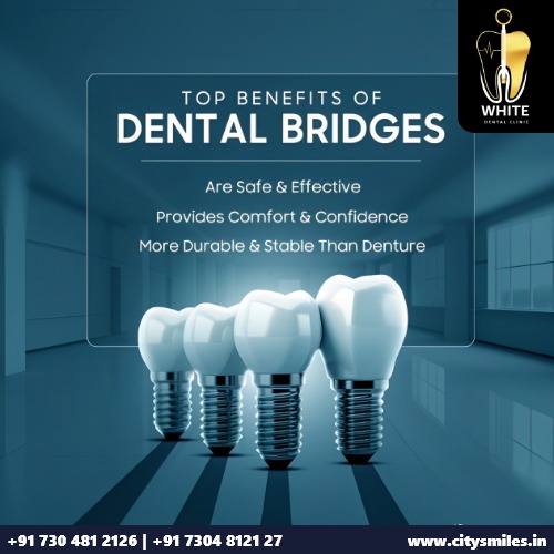 TOP BENEFITS OF DENTAL BRIDGES