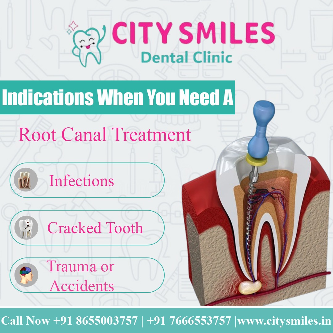 Say Goodbye to Tooth Pain with Expert Root Canal Treatment at City Smiles Dental Clinic!