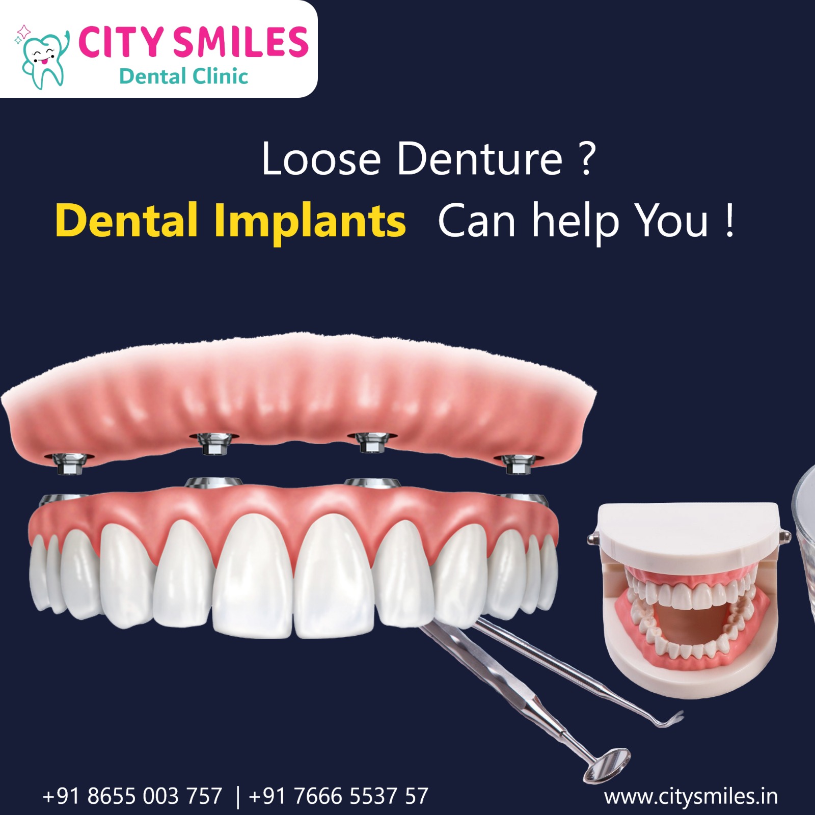 Say Goodbye to Loose Dentures with Dental Implants