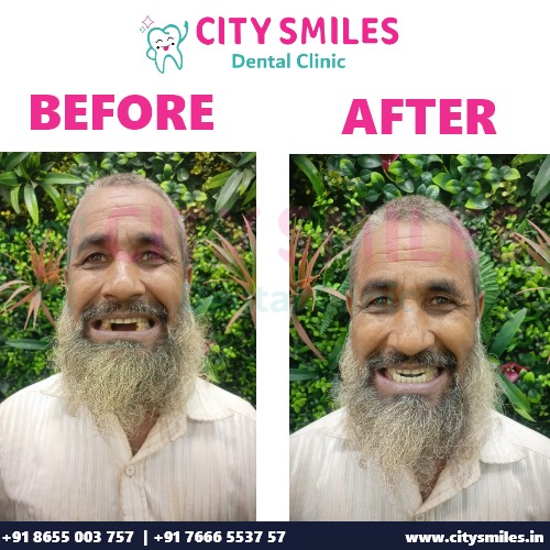 Transform Your Smile: Before and After at City Smiles Dental Clinic