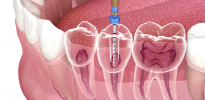 Root canal Treatment