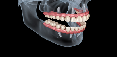 Full Mouth Reconstruction