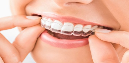 Braces / Aligners