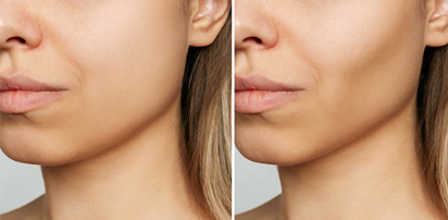 Buccal Fat Pad Removal for Face Contouring